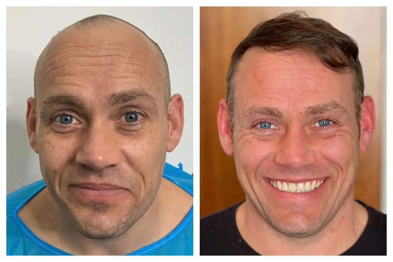 B&A hair transplant temporal point - Patient 2