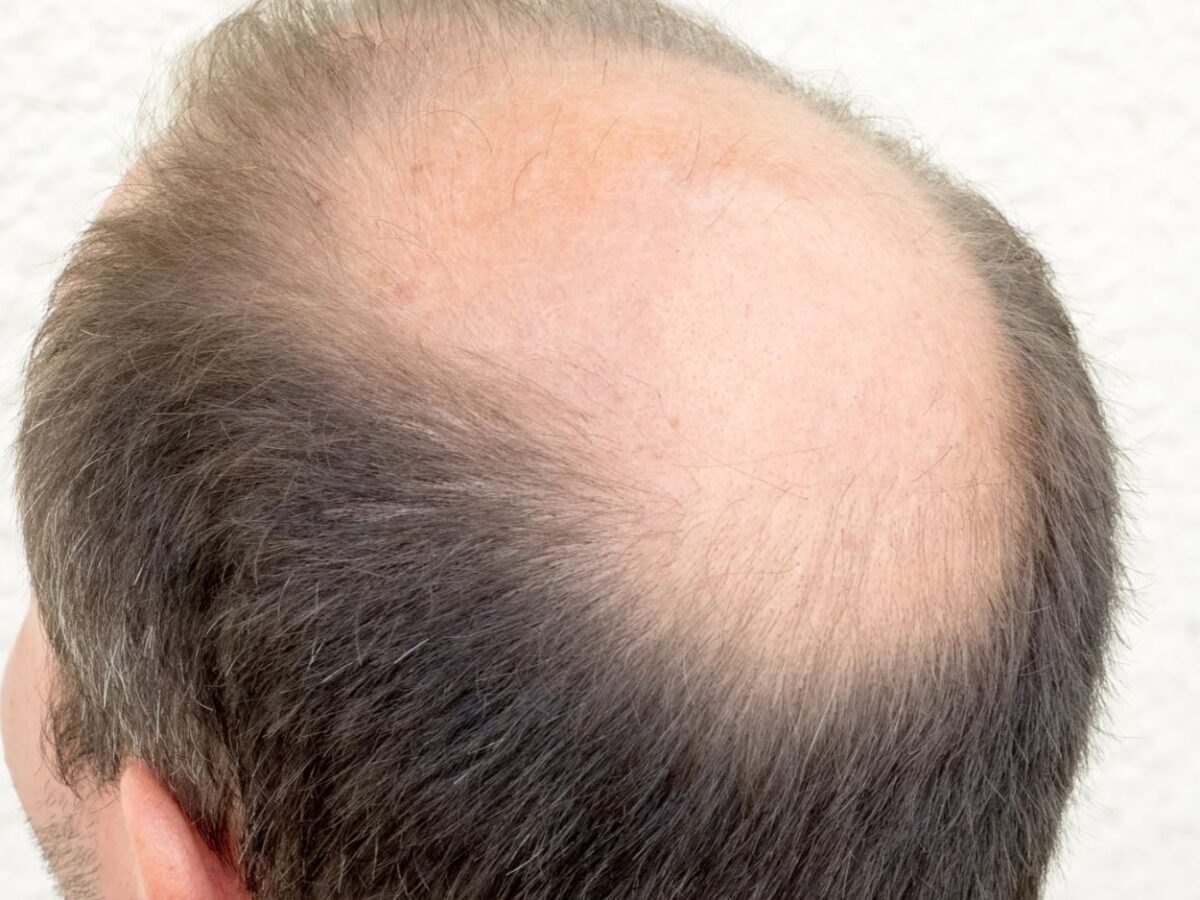 FUT Hair Transplant Pricing: A Complete Guide to Costs and Estimates